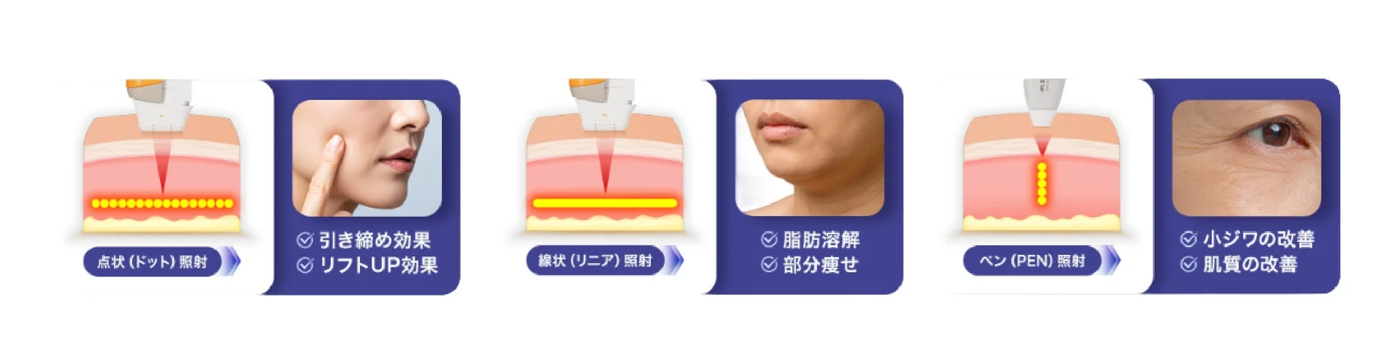 点状、線状、ペン状の3種類の照射治療による美容効果を説明する画像