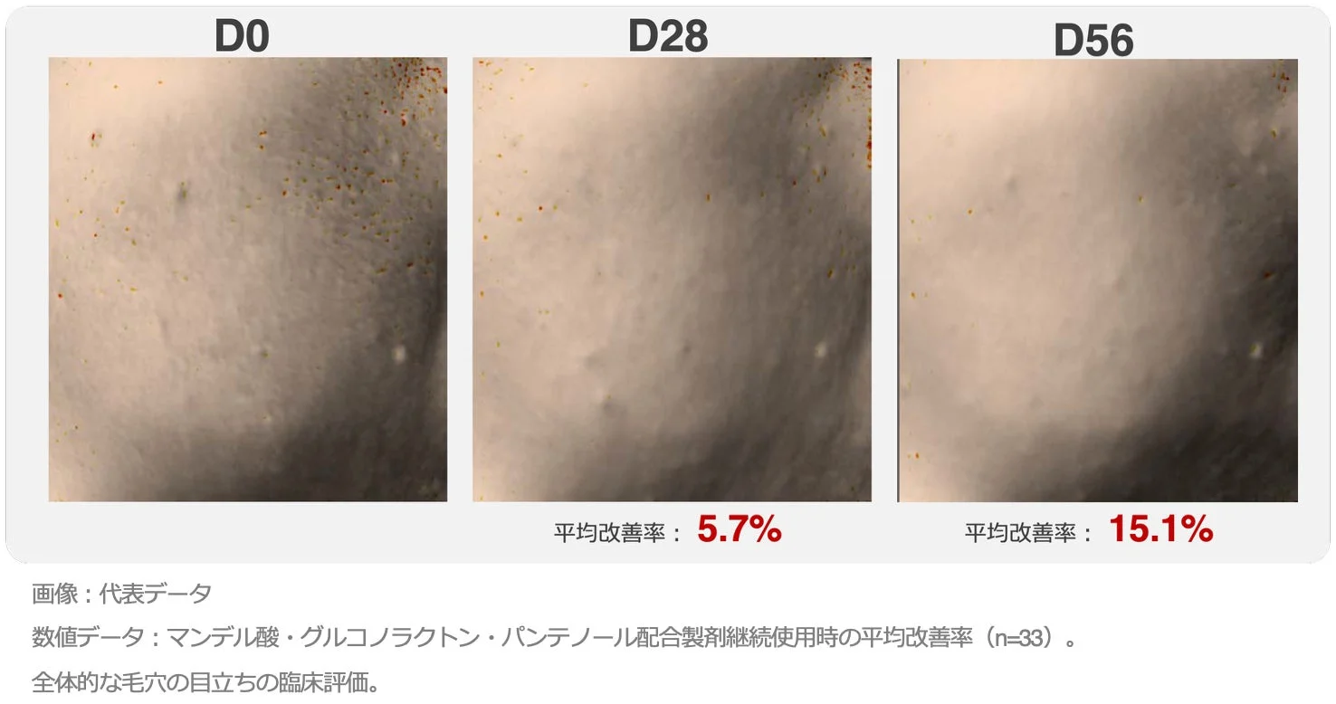 毛穴の目立ち改善例