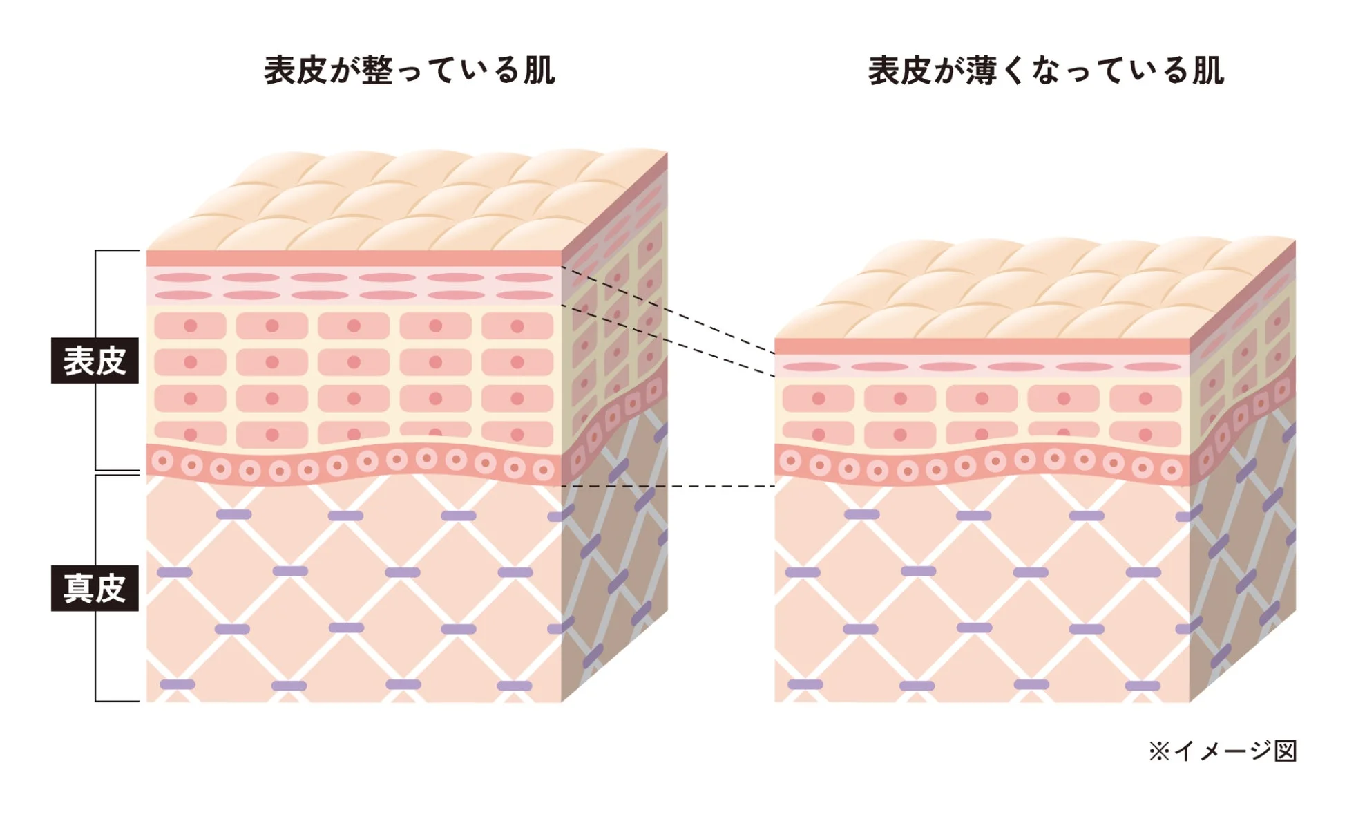 表皮が整っている肌と薄くなっている肌の比較イラスト