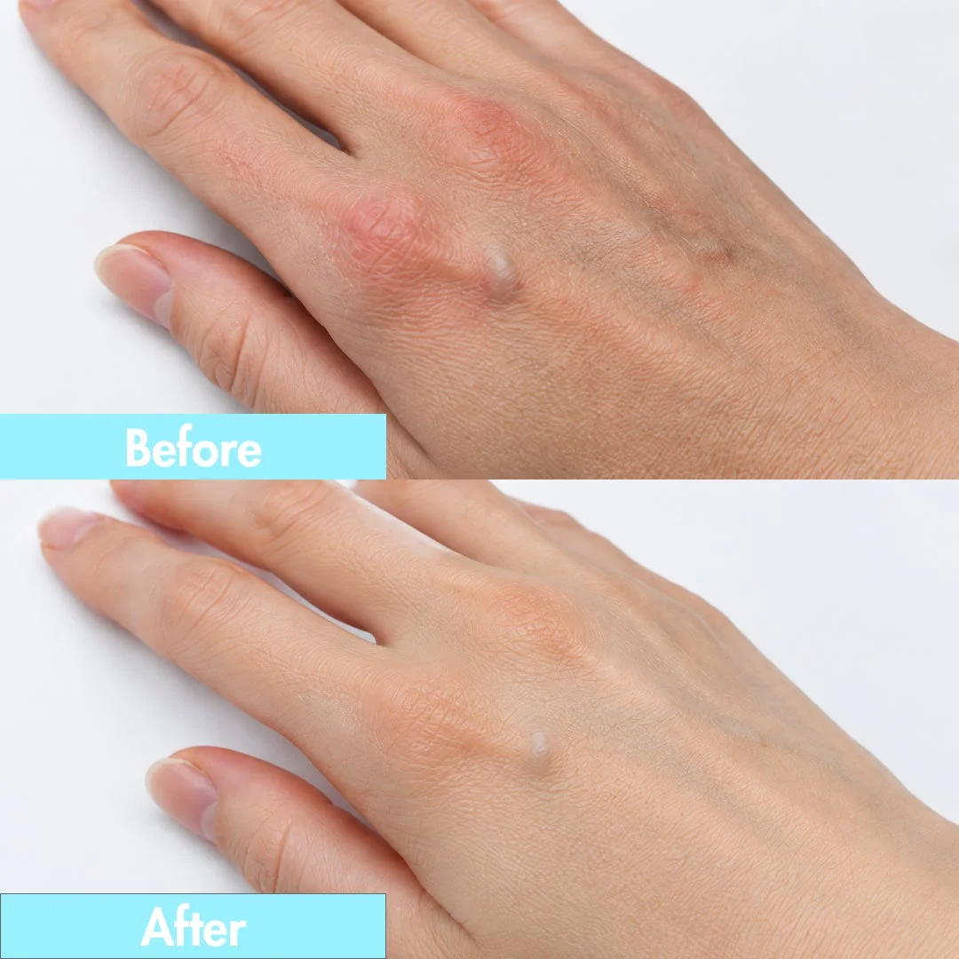 手の甲にできた腫れやこぶの治療前と治療後を比較した画像
